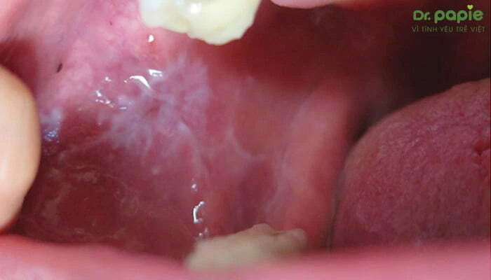 5+ cách trị trắng lưỡi ở trẻ sơ sinh an toàn, hiệu quả tại nhà Trẻ bị Lichen