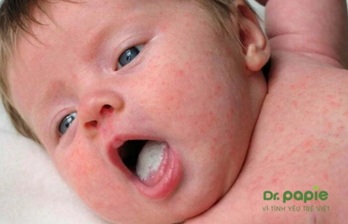 5 dấu hiệu tưa lưỡi ở trẻ sơ sinh và cách chăm sóc tại nhà Trẻ bị tưa lưỡi (tưa miệng)