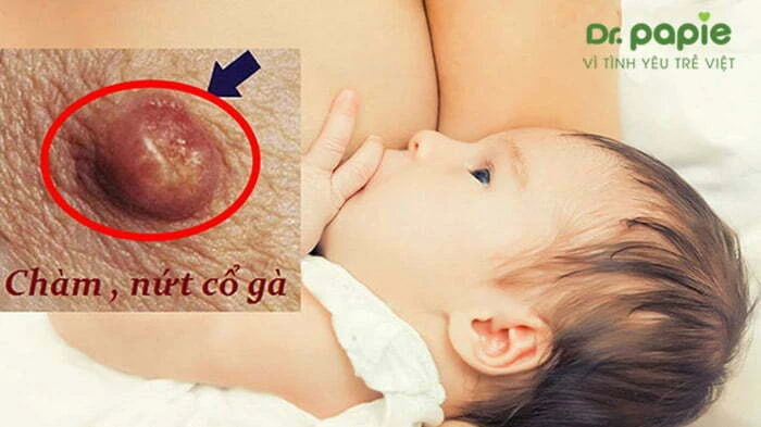 5 dấu hiệu tưa lưỡi ở trẻ sơ sinh và cách chăm sóc tại nhà Nấm miệng ở trẻ em lây sang mẹ