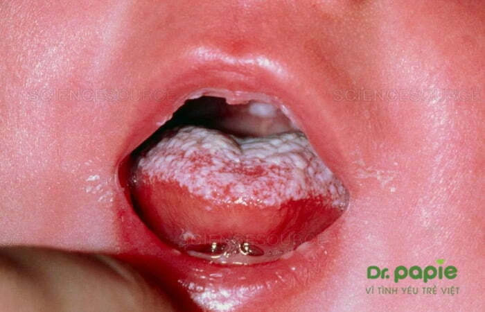5 dấu hiệu tưa lưỡi ở trẻ sơ sinh và cách chăm sóc tại nhà Trẻ bị tưa lưỡi giả mạc