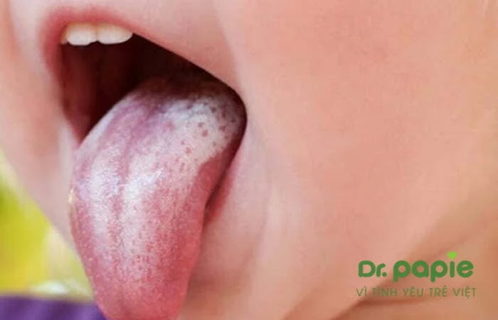 5 dấu hiệu tưa lưỡi ở trẻ sơ sinh và cách chăm sóc tại nhà Bệnh tưa lưỡi ở trẻ sơ sinh
