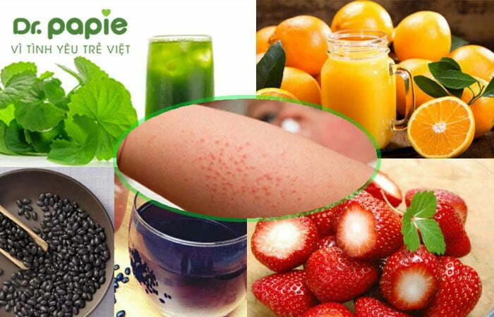 5 nguyên nhân trẻ sơ sinh bị rôm sảy khắp người và cách điều trị tại nhà Các loại nước uống có tính mát cho trẻ sơ sinh bị rôm sảy khắp người