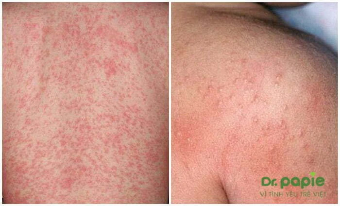5 nguyên nhân trẻ sơ sinh bị rôm sảy ở lưng và cách điều trị đơn giản tại nhà biểu hiện trẻ sơ sinh bị rôm sảy ở lưng