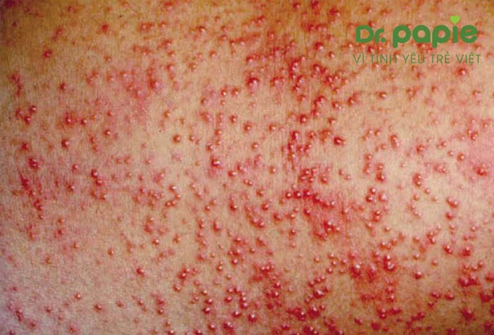 5 nguyên nhân trẻ sơ sinh bị rôm sảy ở lưng và cách điều trị đơn giản tại nhà biến chứng trẻ sơ sinh bị rôm sảy ở lưng