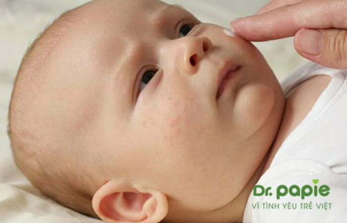 7+ thuốc kem bôi viêm da cơ địa cho trẻ sơ sinh an toàn, dịu nhẹ Bôi kem cho trẻ bị viêm da cơ địa