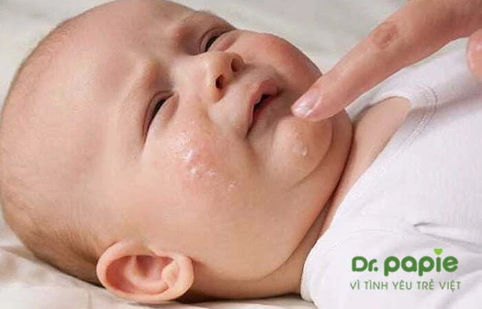 7+ thuốc kem bôi viêm da cơ địa cho trẻ sơ sinh an toàn, dịu nhẹ Thoa kem cho trẻ bị viêm da cơ địa