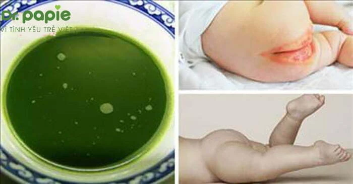 9+ cách trị hăm tã cho bé AN TOÀN áp dụng ngay tại nhà Trị hăm tã bằng lá khế