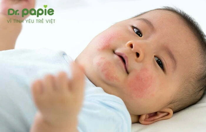 Bé bị chàm sữa có nên tiêm phòng? 10 lưu ý trước và sau khi tiêm Bé bị chàm sữa