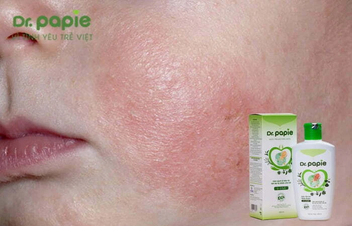 Bé bị viêm da cơ địa nên tắm lá gì? 6 lưu ý khi dùng lá tắm cho trẻ Nước tắm Dr.Papie cho trẻ bị viêm da cơ địa