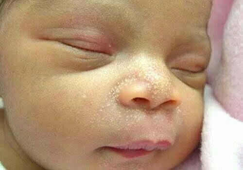 Bé hết chàm sữa, mụn kê nhờ kiên trì tắm thảo dược Dr.Papie các nốt mụn nhân trắng li ti mọc khắc 2 cánh mũi bé sơ sinh