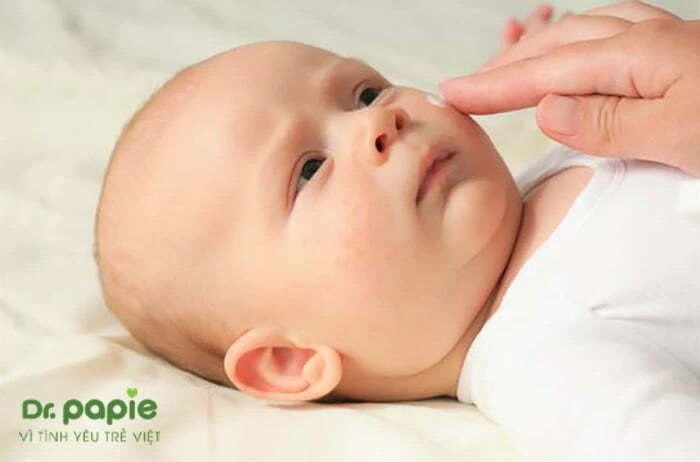 Bị chàm sữa bôi hồ nước có nên không? 5 Lưu ý cho mẹ Cách chữa chàm sữa bằng hồ nước
