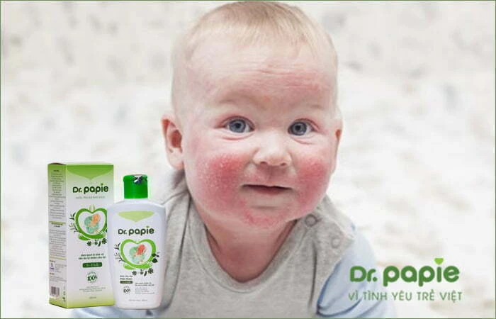 Bị chàm sữa bôi sữa mẹ có được không và cần lưu ý gì khi bôi Dùng nước tắm thảo dược chuyên dụng cho trẻ bị chàm sữa