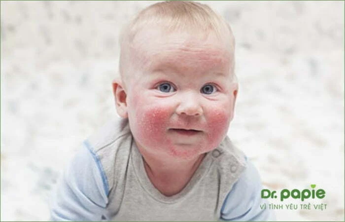 Bị chàm sữa bôi sữa mẹ có được không và cần lưu ý gì khi bôi Trẻ bị chàm sữa ở mặt