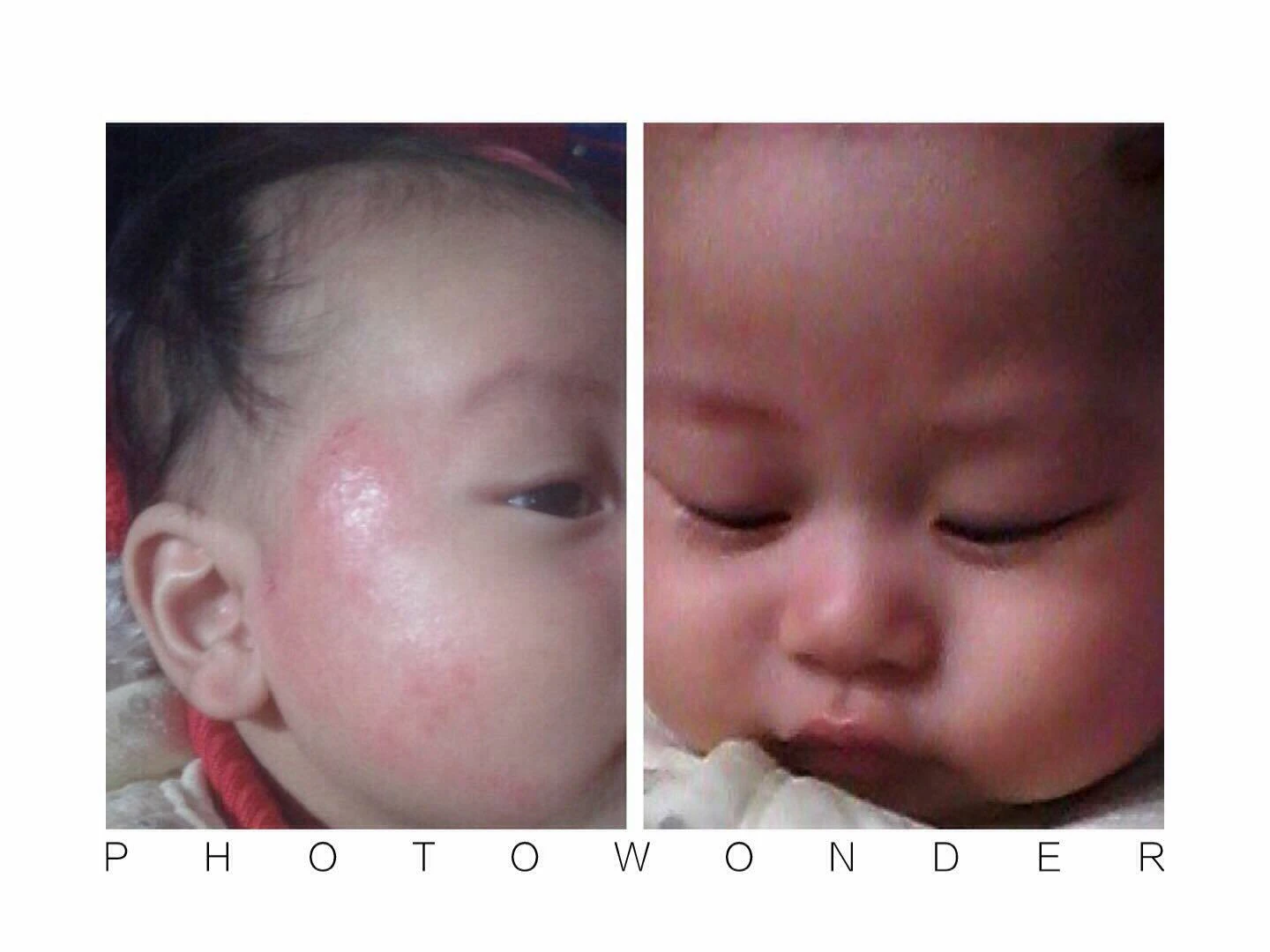 Bí quyết trị chàm cho con 3 tháng tuổi nhờ....tắm Má Bin lúc bị chàm và sau khi dùng nước tắm thảo dược Dr.Papie