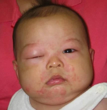 Các bệnh thường gặp ở trẻ sơ sinh Việt chiếm 80% Trẻ bị mề đay nổi phù hết cả mặt