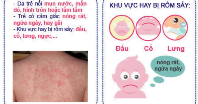 Các bệnh thường gặp ở trẻ sơ sinh Việt chiếm 80% Biểu hiện đặc trưng của trẻ bị rôm sảy