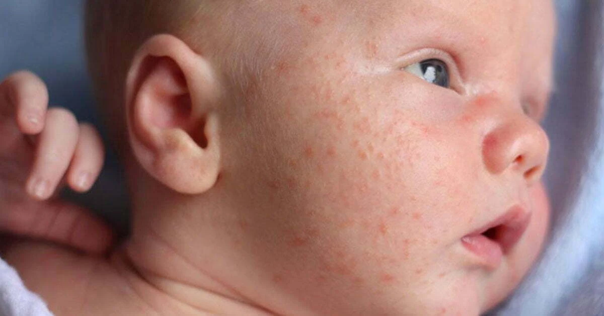 Các vấn đề thường gặp ở da trẻ và cách bảo vệ da của trẻ đúng cách cac van de thuong gap o da tre va cach bao ve da cua tre dung cach