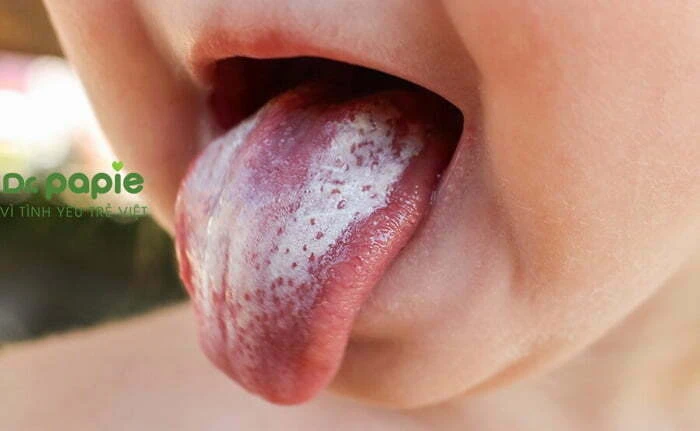 Cách chữa lưỡi trắng cho trẻ sơ sinh, áp dụng ngay tại nhà Lưỡi trẻ sơ sinh bị trắng