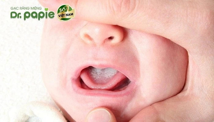 cach dieu tri benh nam mieng o tre em hieu qua nhat