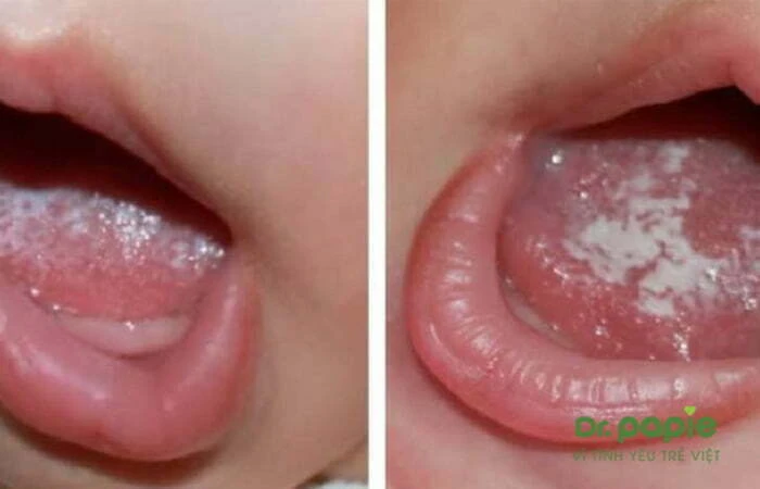 Cách điều trị và phòng ngừa tái phát nấm lưỡi ở trẻ em Nấm lưỡi ở trẻ em