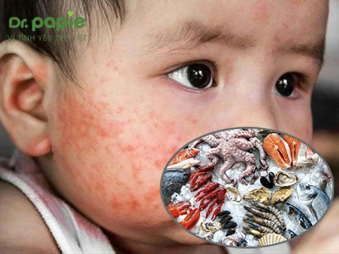 Chàm sữa bị chảy nước: 3 Nguyên nhân, 8 cách chữa dứt điểm không ăn hải sản khi bị chàm sữa chảy nước