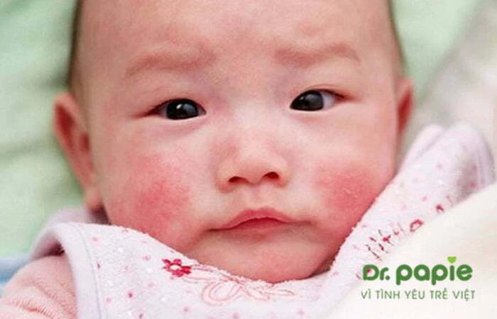 Chàm sữa bội nhiễm: Nguyên nhân, triệu chứng và cách điều trị dứt điểm trẻ bị chàm sữa bội nhiễm