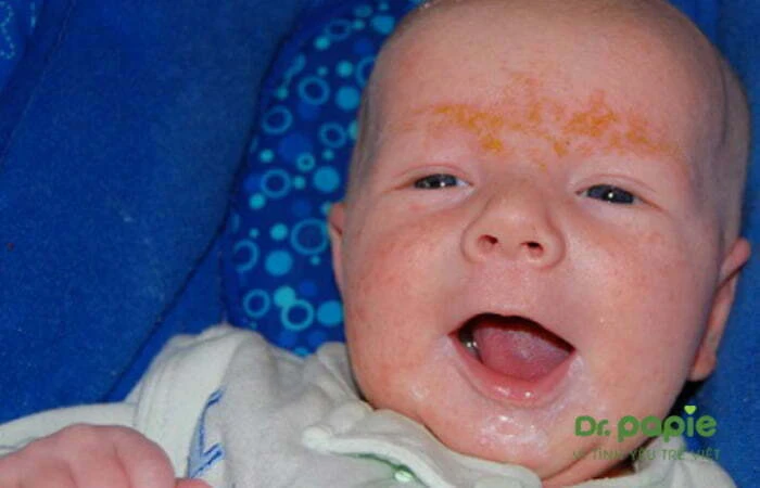 Chàm sữa có để lại sẹo không? Và cách điều trị dứt điểm chàm sữa Trẻ bị chàm sữa ở mặt