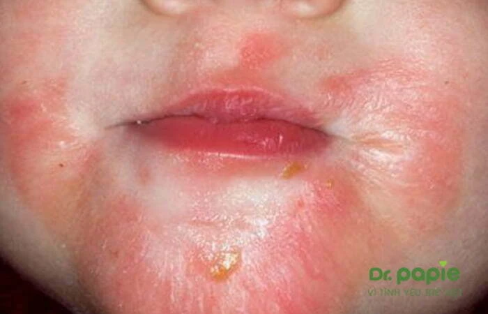 Chàm sữa có để lại sẹo không? Và cách điều trị dứt điểm chàm sữa Trẻ bị chàm sữa nặng