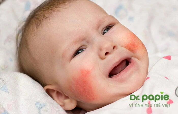 Trẻ bị chàm sữa ở hai bên má