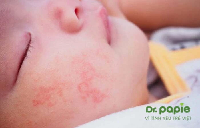 Trẻ bị chàm sữa