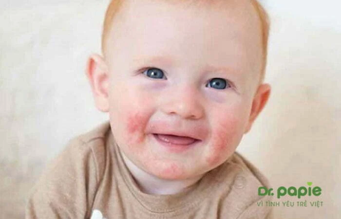 Chàm sữa có tự khỏi không, bao lâu thì khỏi và cách chăm sóc để trẻ nhanh khỏi bệnh nhất Chàm sữa trên mặt của bé