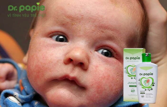 Chàm sữa có tự khỏi không, bao lâu thì khỏi và cách chăm sóc để trẻ nhanh khỏi bệnh nhất Điều trị chàm sữa bằng các loại lá thảo dược