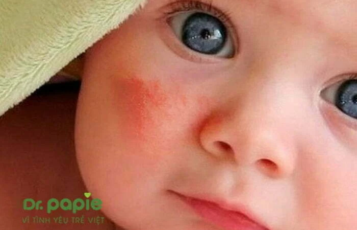 Chàm sữa khô có nguy hiểm không? Nguyên nhân và cách chăm sóc Bé sơ sinh bị chàm sữa khô
