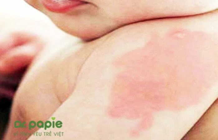 Chàm sữa ở tay: Nguyên nhân, triệu chứng và cách điều trị Ảnh da bé bị mẩn đỏ do chàm sữa