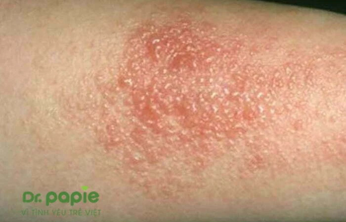 Chàm sữa ở tay: Nguyên nhân, triệu chứng và cách điều trị Ảnh mụn nước do chàm sữa ở tay bé