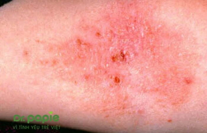 Chàm sữa ở tay: Nguyên nhân, triệu chứng và cách điều trị Ảnh vết loét do chàm sữa gây ra trên tay bé
