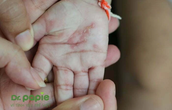 Chàm sữa ở tay: Nguyên nhân, triệu chứng và cách điều trị  Ảnh vết chàm sữa trên tay bé đã khô đã khô