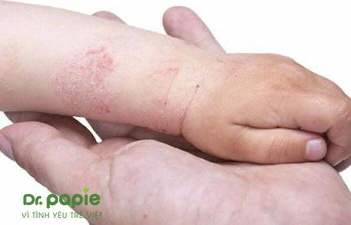 Chàm sữa ở tay: Nguyên nhân, triệu chứng và cách điều trị   Ảnh vết bong vảy biểu hiện chàm sữa trên tay đã khỏi