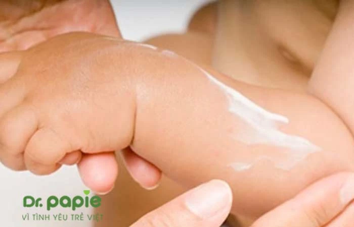 Chàm sữa ở tay: Nguyên nhân, triệu chứng và cách điều trị Bôi kem trị chàm sữa vào tay trẻ