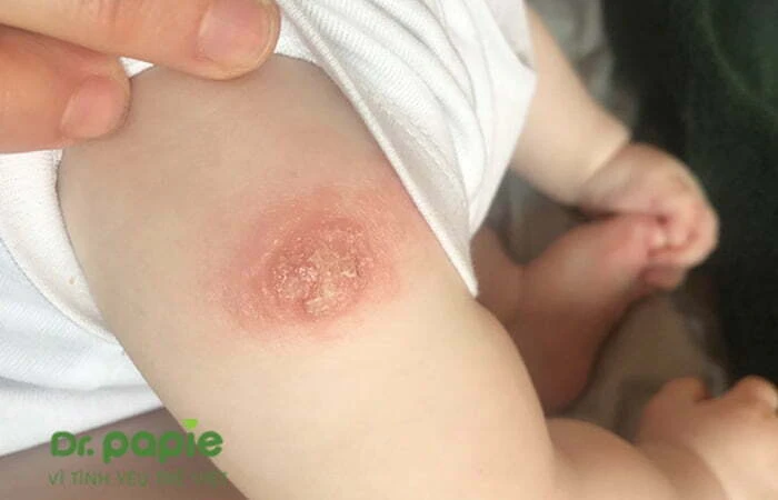 Chàm sữa ở tay: Nguyên nhân, triệu chứng và cách điều trị Chàm sữa ở tay trẻ nhỏ