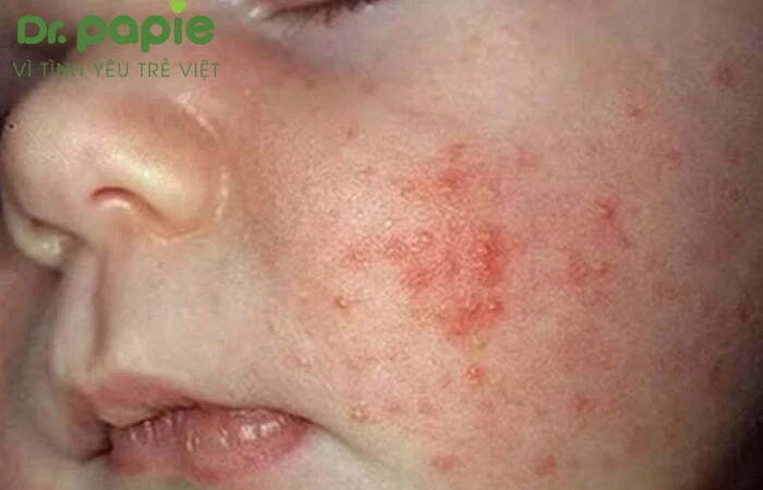 Chẩn đoán nhanh với 4 biểu hiện rôm sảy ở trẻ sơ sinh Biểu hiện rôm sẩy đỏ ở trẻ sơ sinh