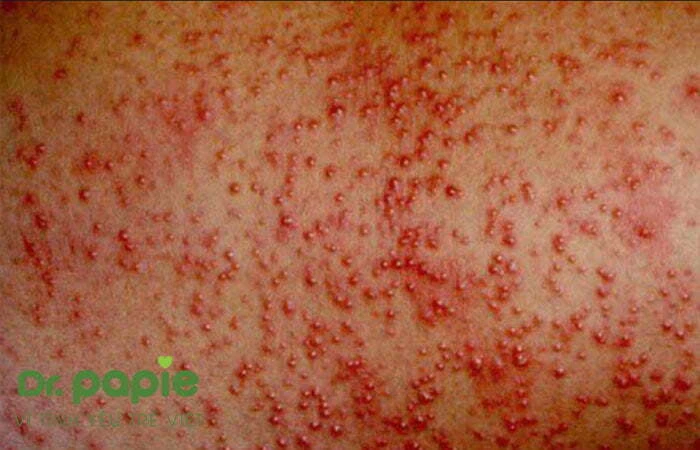 Chẩn đoán nhanh với 4 biểu hiện rôm sảy ở trẻ sơ sinh Biểu hiện rôm sảy sâu ở trẻ sơ sinh