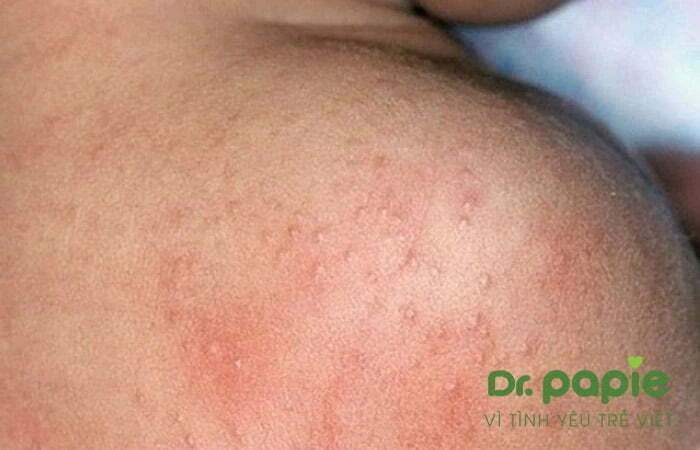 Chẩn đoán nhanh với 4 biểu hiện rôm sảy ở trẻ sơ sinh Biểu hiện rôm sảy ở vai trẻ sơ sinh