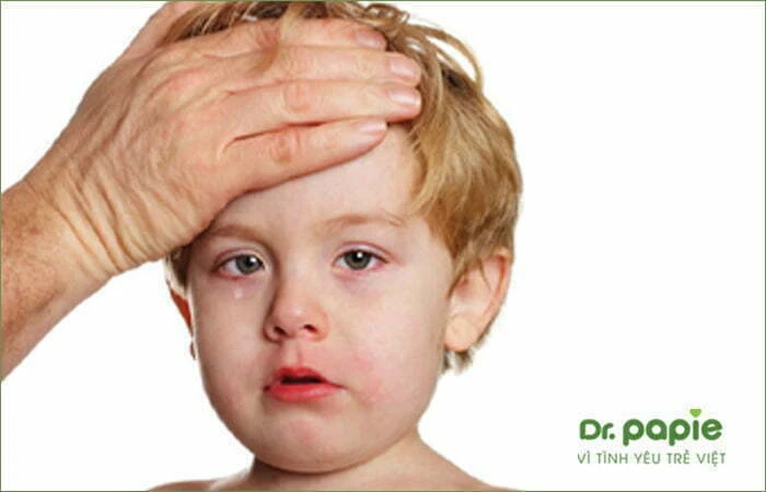 Chuỗi 17+ hình ảnh sốt phát ban ở trẻ giúp mẹ chuẩn đoán nhanh bệnh Hình ảnh trẻ bị đỏ mắt, tăng tiết dịch mũi, mắt trước phát ban