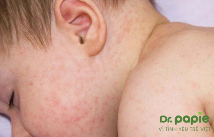 Chuỗi 17+ hình ảnh sốt phát ban ở trẻ giúp mẹ chuẩn đoán nhanh bệnh Hình ảnh vết ban đỏ li ti dần xuất hiện trên da bé trong giai đoạn phát ban