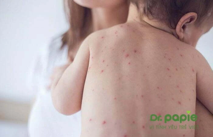 Chuỗi 17+ hình ảnh sốt phát ban ở trẻ giúp mẹ chuẩn đoán nhanh bệnh Hình ảnh các ban đỏ để lại vết thâm trên da trẻ