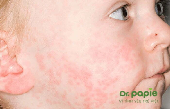 Chuỗi 17+ hình ảnh sốt phát ban ở trẻ giúp mẹ chuẩn đoán nhanh bệnh Hình ảnh trẻ nổi ban trên mặt