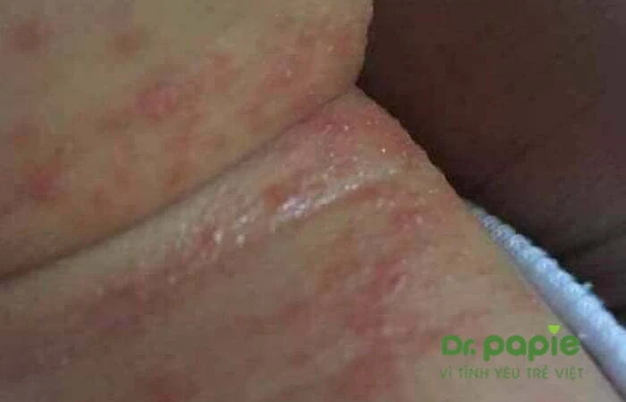 Chuỗi 17+ hình ảnh sốt phát ban ở trẻ giúp mẹ chuẩn đoán nhanh bệnh Hình ảnh trẻ bi phát ban ở cổ