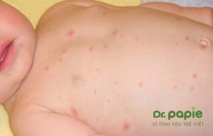 Chuỗi 17+ hình ảnh sốt phát ban ở trẻ giúp mẹ chuẩn đoán nhanh bệnh Hình ảnh pát ban trên bụng