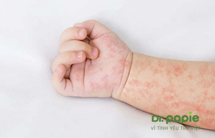 Chuỗi 17+ hình ảnh sốt phát ban ở trẻ giúp mẹ chuẩn đoán nhanh bệnh Hình ảnh sốt phát ban ở tay đang lan xuống cổ tay